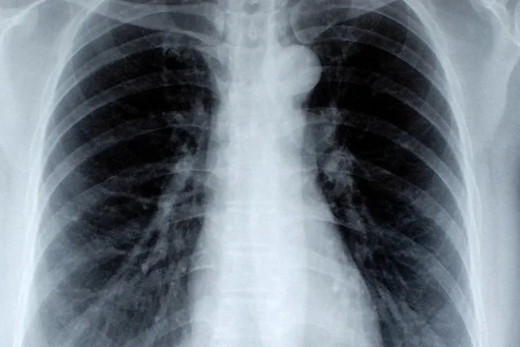Rak pluća u Srbiji svaki dan odnese 13 života. Znate li ko je najugroženiji?