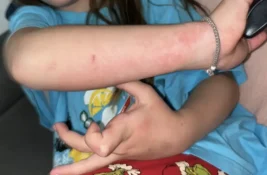 (FOTO) Stara Pazova: Roditelji ukazuju na iritacije kože kod dece u PU „Poletarac“, danas sednica Upravnog odbora